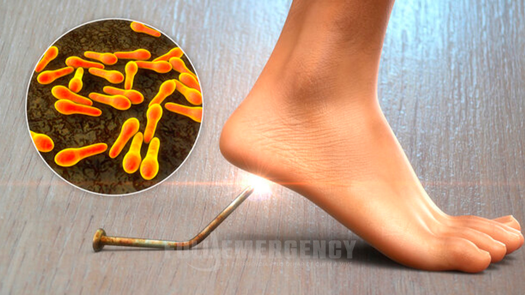 Manejo do Tétano no Departamento de Emergência